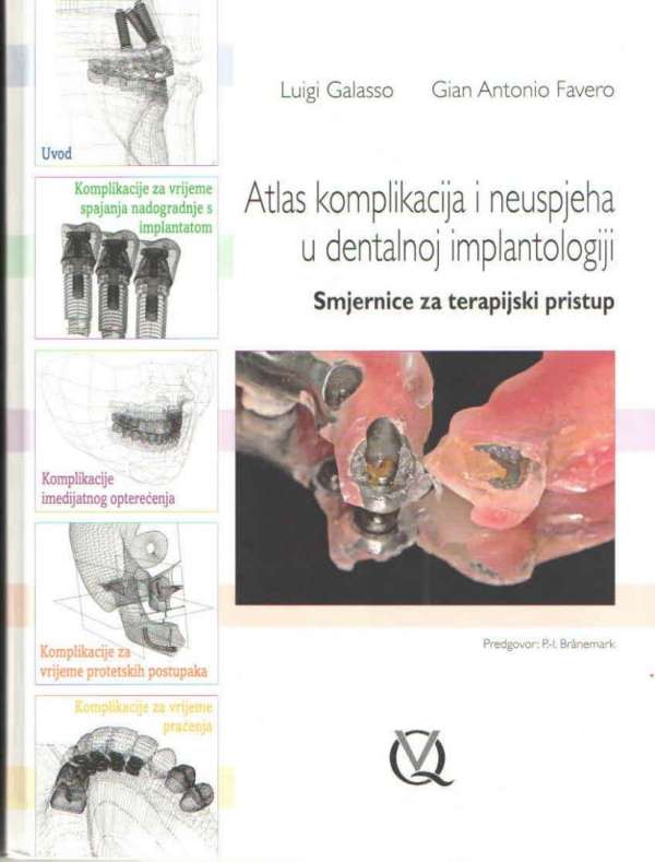 Atlas komplikacija i neuspjeha u dentalnoj implantologiji - Smjernice za terapijski pristup